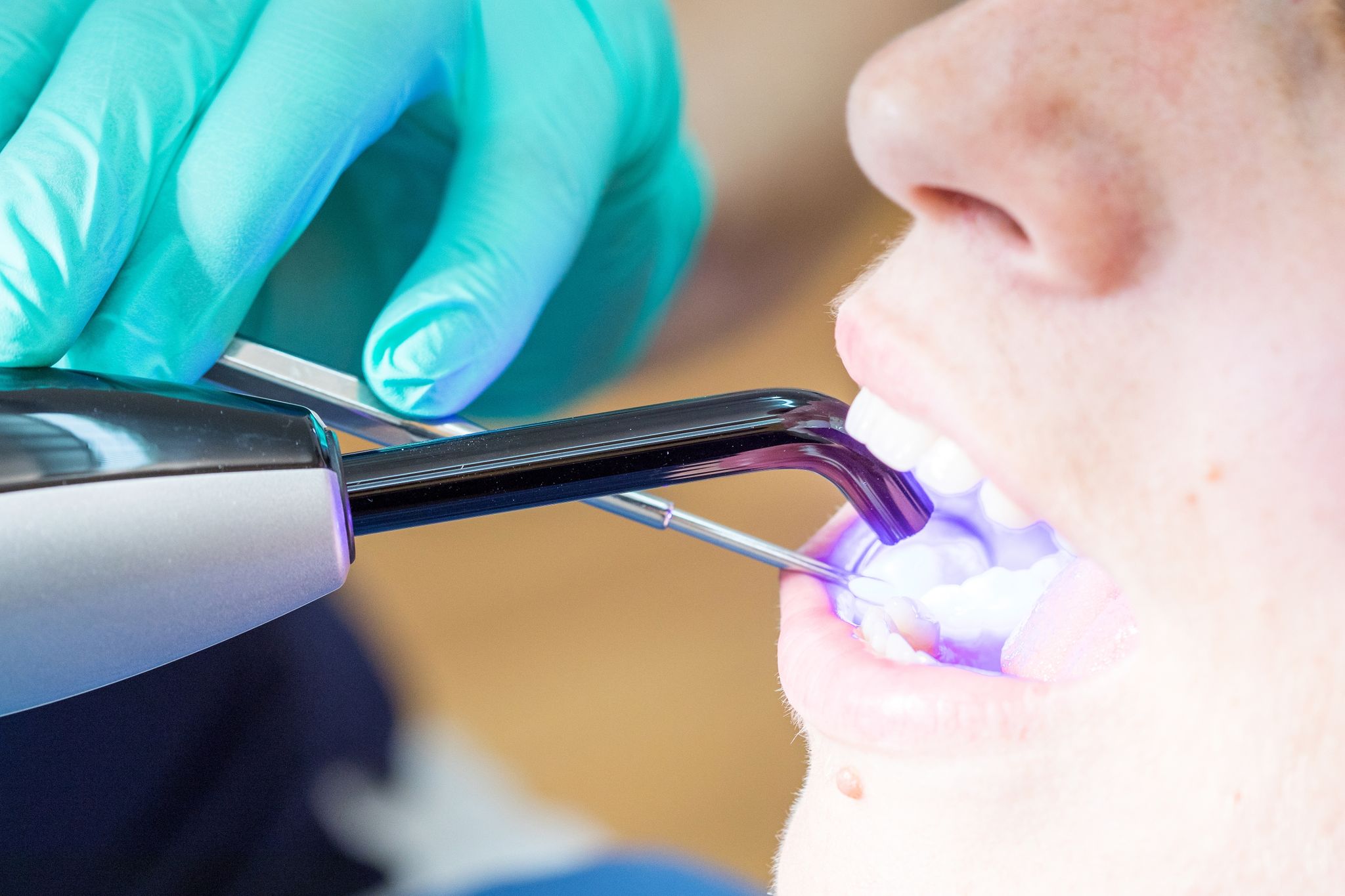 Zahnfüllungen: Komposit und Co. verdrängen Amalgam
