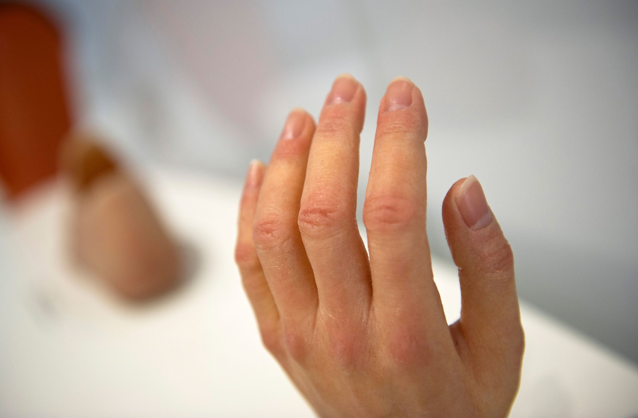 Anspruch auf maßgefertigte Silikonprothese bei Fingerverlust