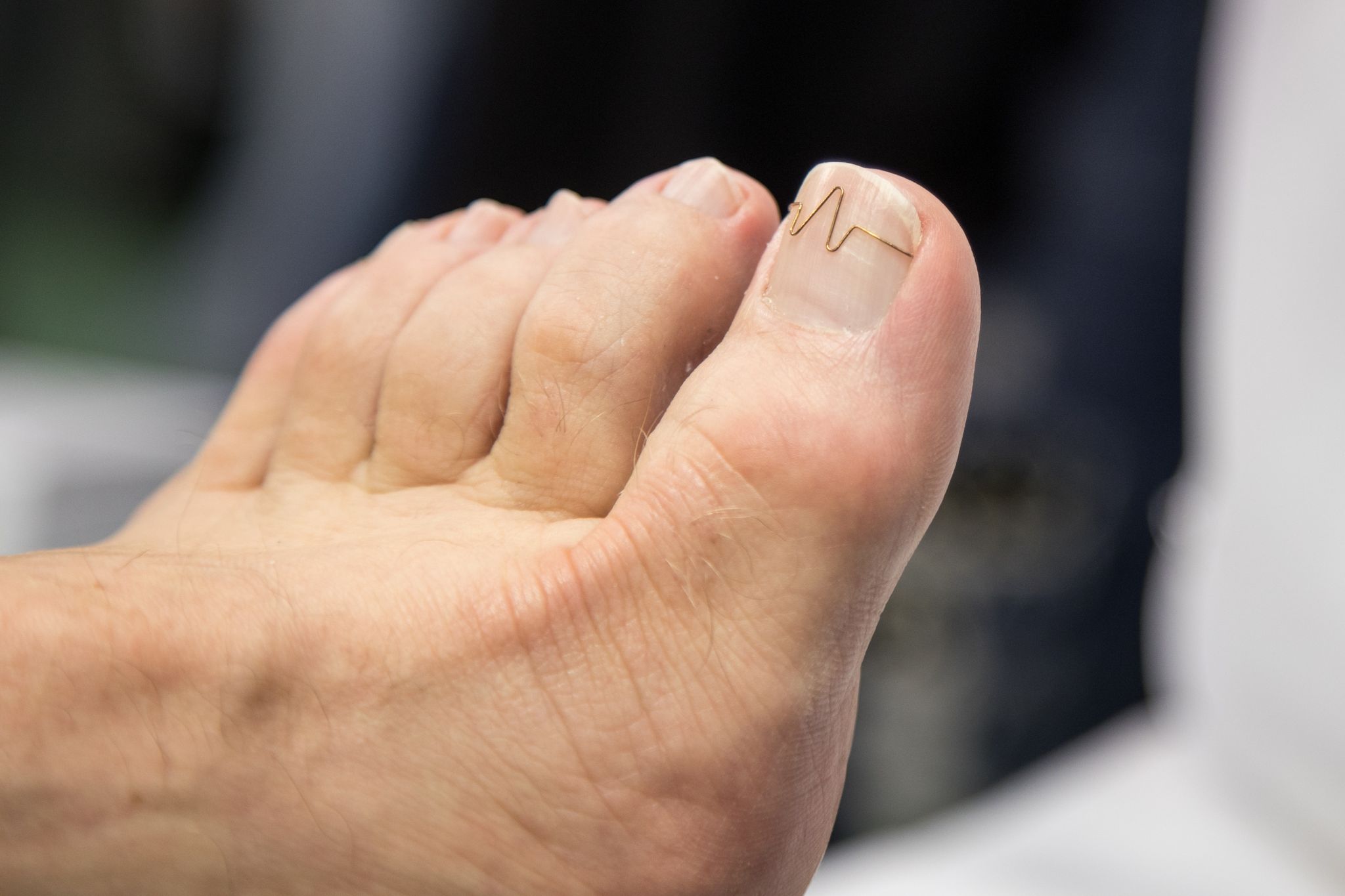 Nagelspangenbehandlung bei Podologen auf Kassenkosten kommt