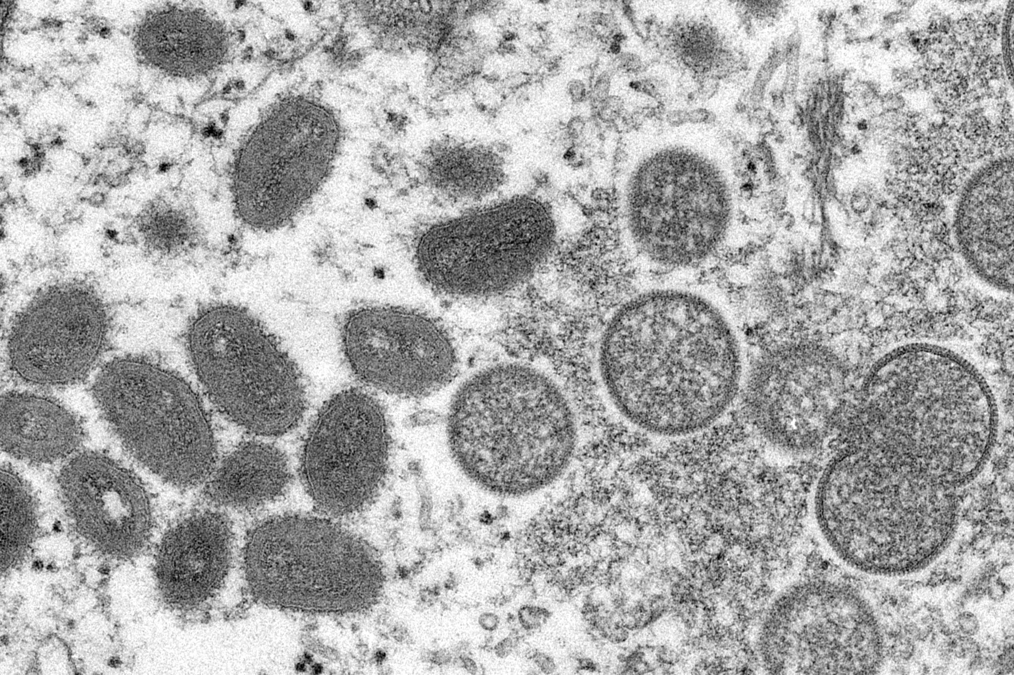 Affenpocken-Fälle weltweit: Was hat das zu bedeuten?