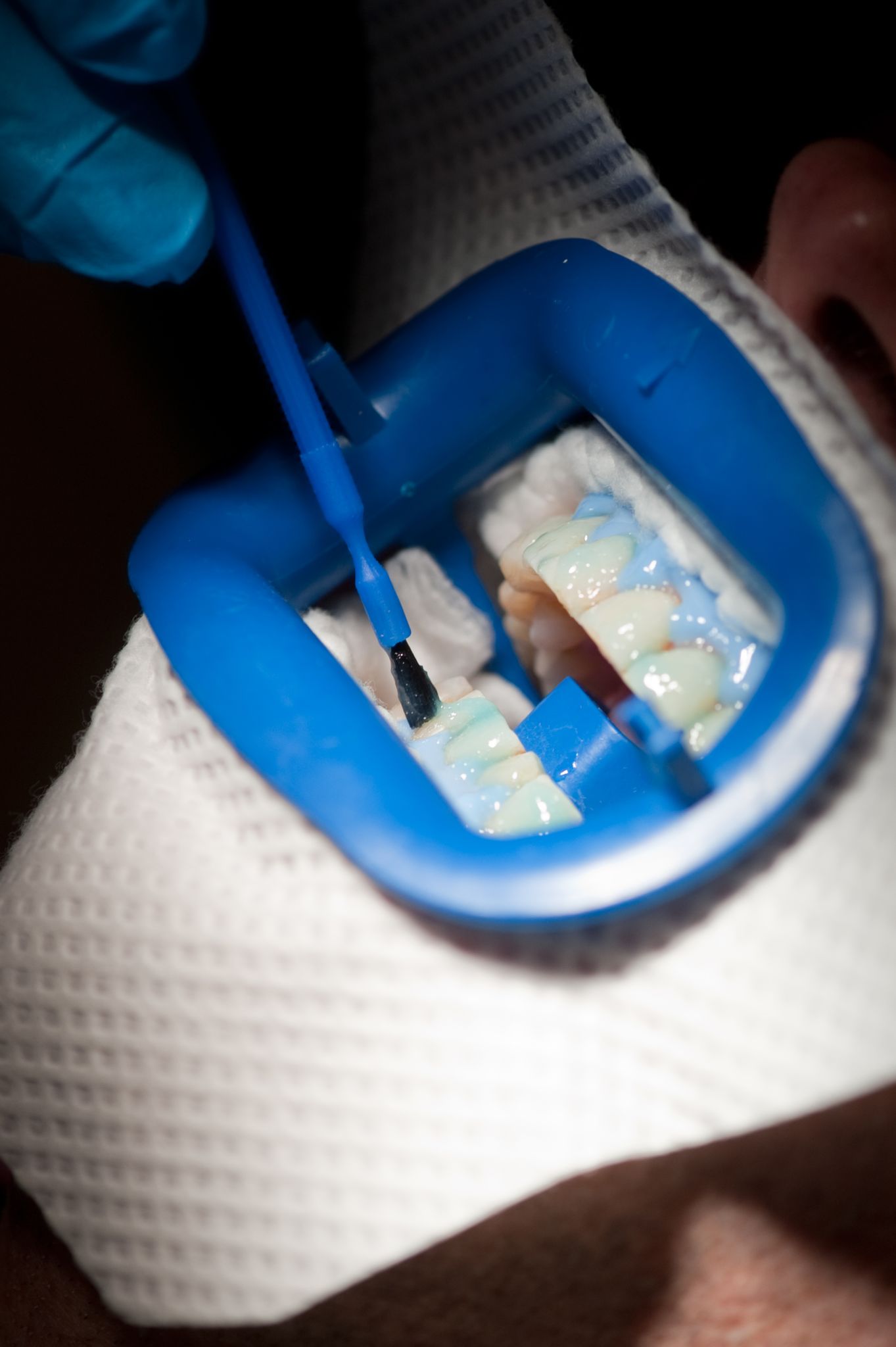 Bleaching-Produkte: Was macht die Zähne wieder weiß?