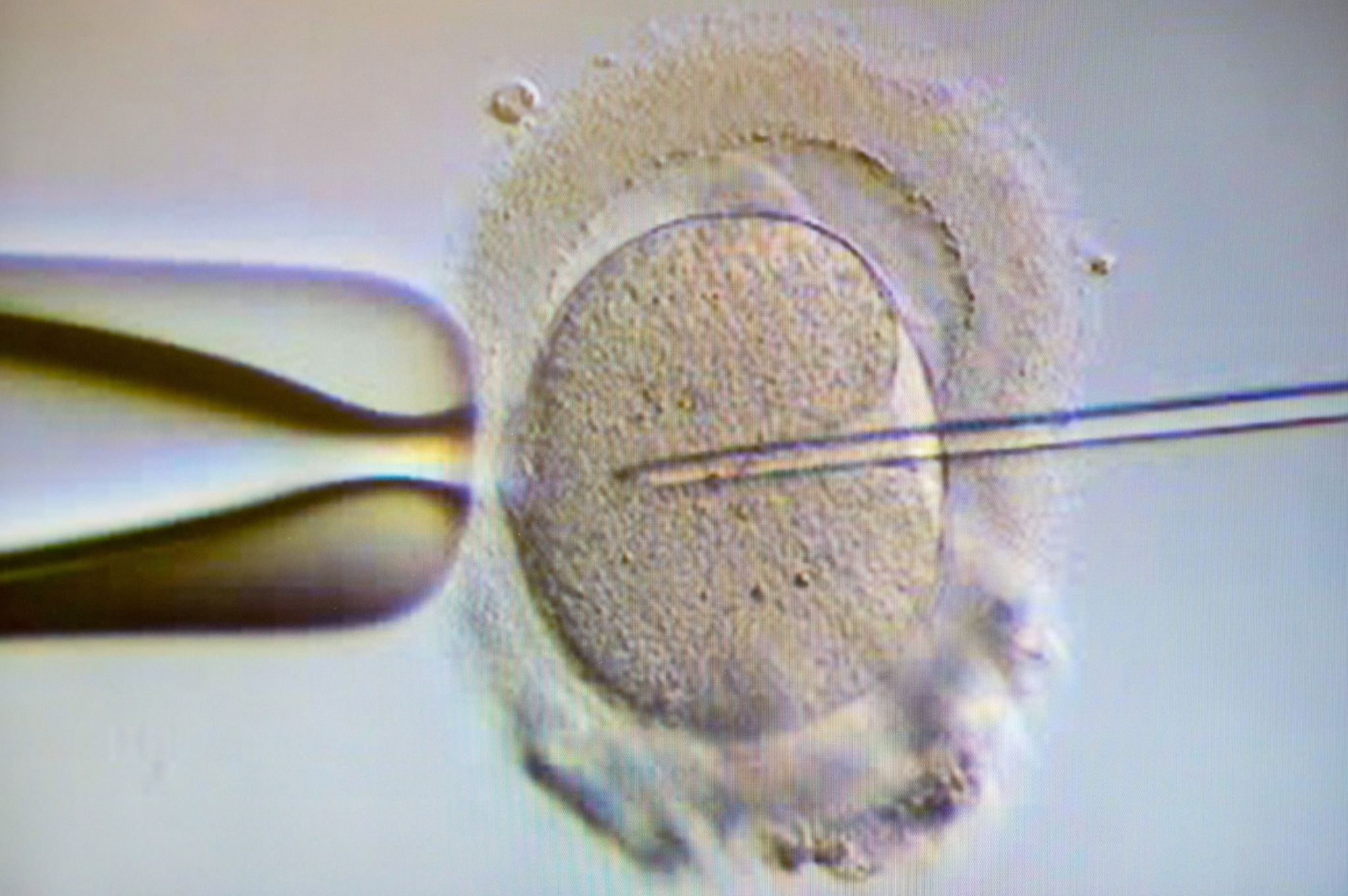 44 Jahre IVF: Kosten für Kinderwunsch immer noch zu hoch