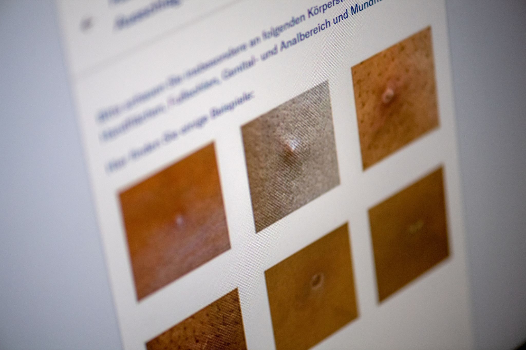 Mit Affenpocken-App Ausschlag analysieren