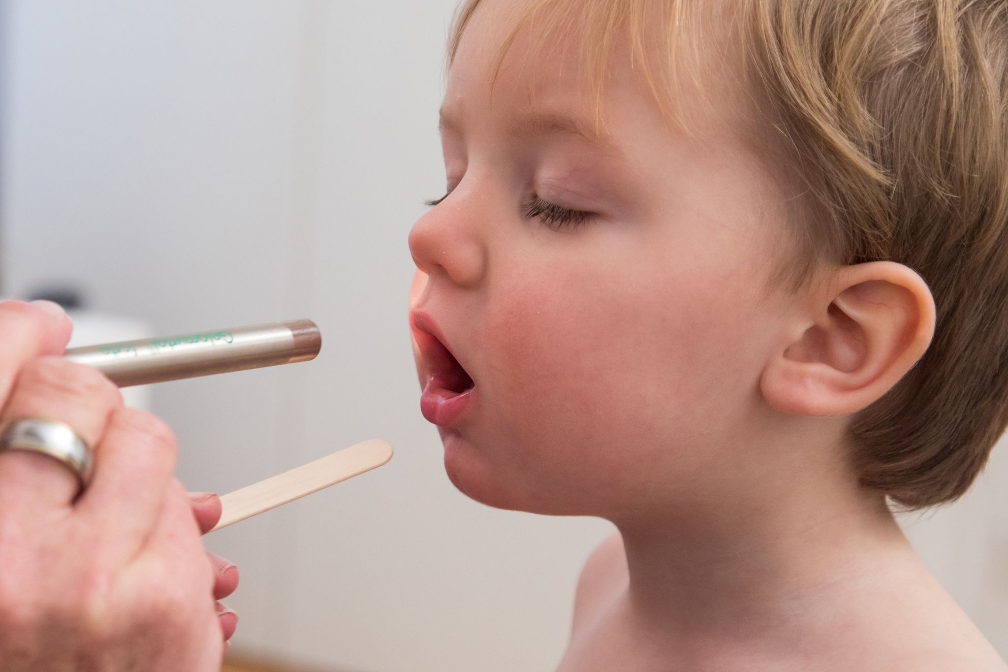 Mehr Kinder betroffen: Das sind Anzeichen für Scharlach