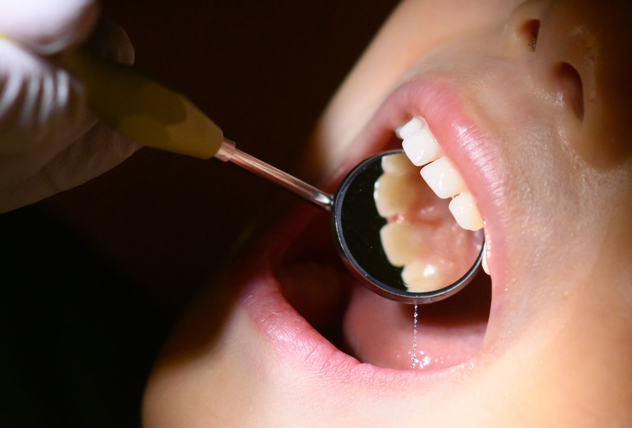Fluoridlack für Kinder unter sechs Jahren Kassenleistung