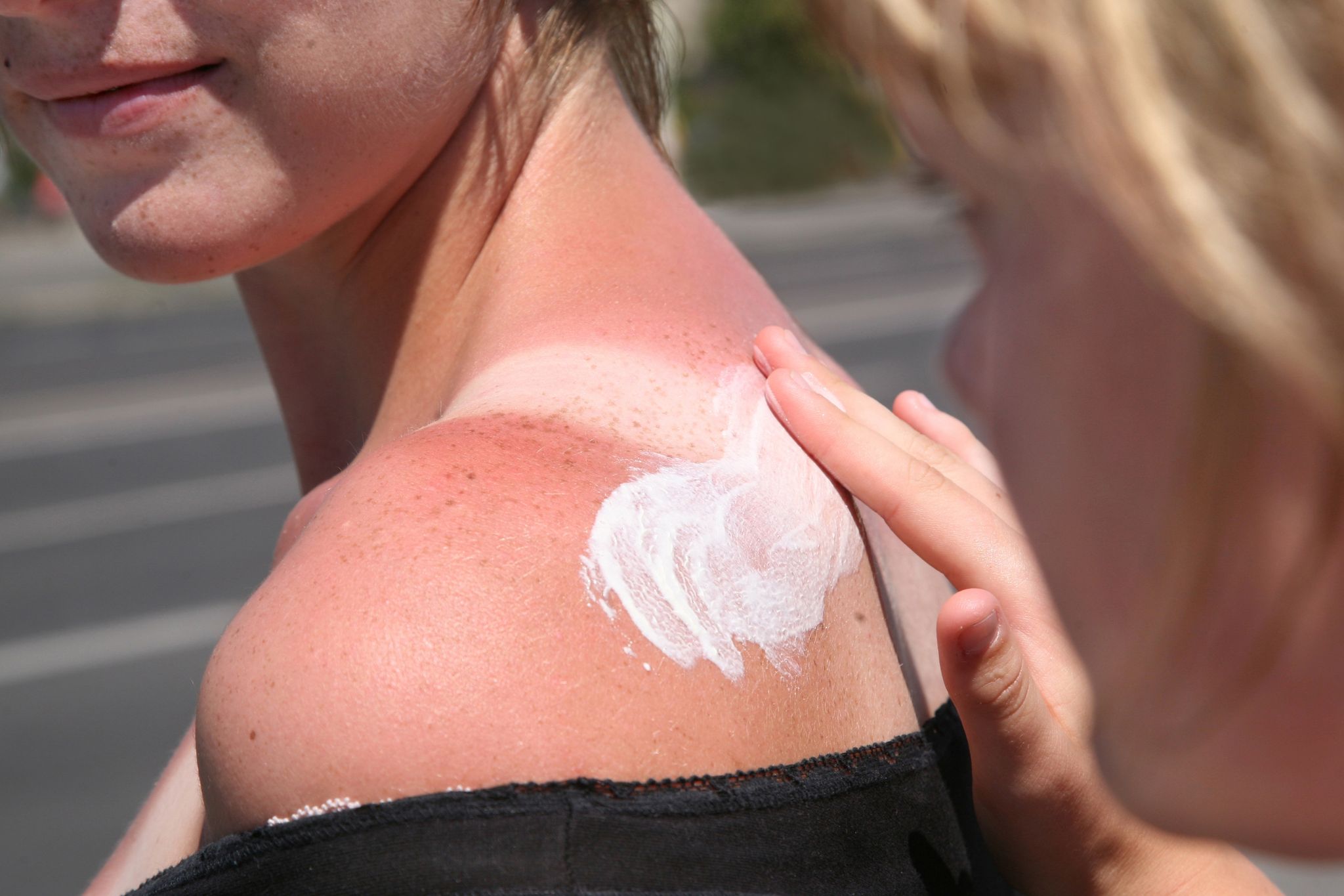 Von Quark bis Tee: Mit Hausmitteln gegen den Sonnenbrand