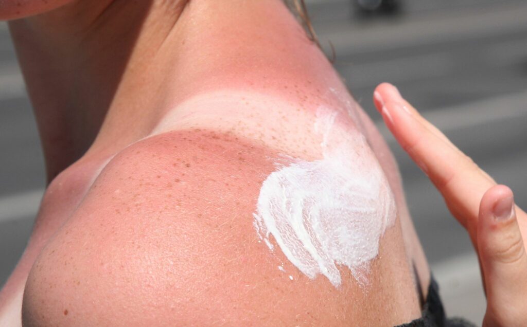 Knallrot und mit Blasen: Was hilft bei starkem Sonnenbrand?