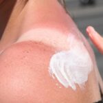 Knallrot und mit Blasen: Was hilft bei starkem Sonnenbrand?