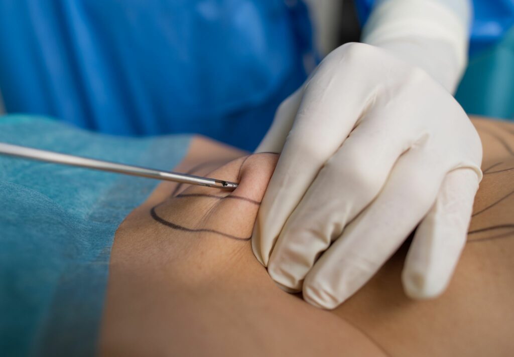 Kasse zahlt Lipödem-OP: Was das für Patientinnen bedeutet