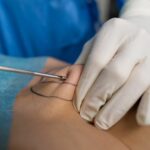 Kasse zahlt Lipödem-OP: Was das für Patientinnen bedeutet