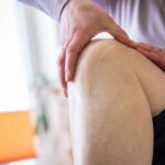 Was hilft, wenn mich das Aussehen einer Narbe belastet?